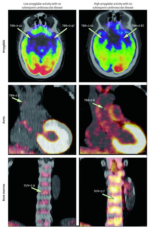 Scan ***EMBARGOED 11.30PM, WED JAN 11TH (23:30 GMT)*** Some of the high tech scans See National story NNSTRESS; Stress really may increase the risk of heart disease and strokes, reveals new research. Scientists who analysed a series of high tech brain scans found heightened activity in the amygdala – a region of the brain involved in stress – is associated with a greater risk of heart disease and stroke. The study, published in The Lancet, provides new insights into the possible mechanism by which stress can lead to cardiovascular disease in humans. While more further and larger studies are needed to confirm the mechanism, the researchers suggest that their findings could eventually lead to new ways to target and treat stress-related cardiovascular risk.