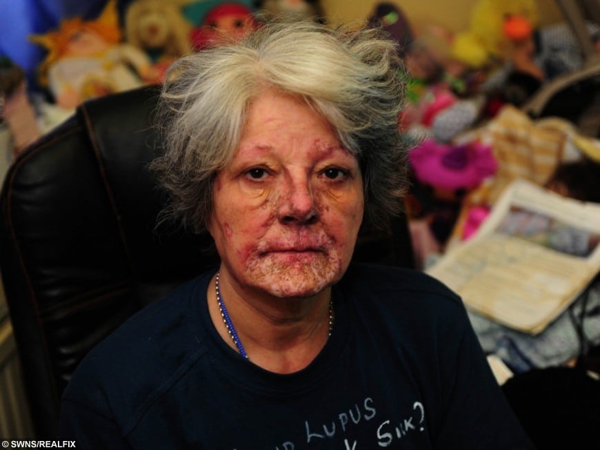 Woman Trapped In House With Flesh Eating Disease Has Benefits Cut After Being Deemed Fit To Work