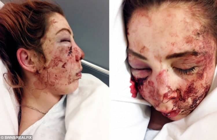 Autistic Teen Brutally Beaten By Female Yob Is Left With Horrific Injuries