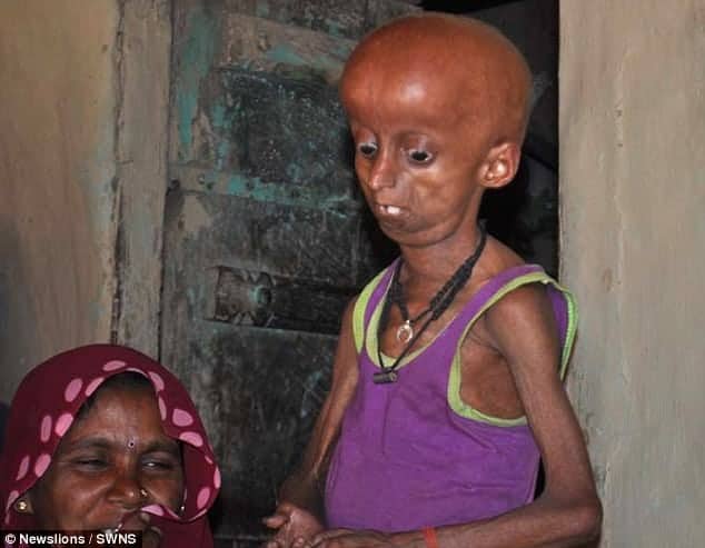 Watch – World’s oldest ‘Benjamin Button’ – 21-y-o man has body of someone who is 160