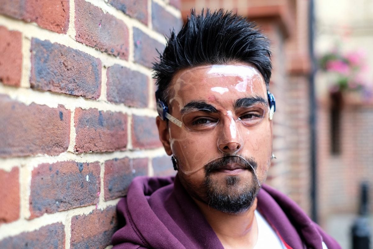Samir Hussain wearing a face mask - which he keeps on 24 hours a day - as he recovered from burns suffered in an acid attack.  (file pic) See National News story NNACID; Two men have admitted their part in throwing acid in a cinema-goer's face outside a screening of Straight Outta Compton after shouting "you can seen gangsters now". Samir Hussain was left with life-changing injuries from the horrific burns following the attack at a Cineworld.  The 28-year-old still has to wear a face mask 18 months after the attack in Crawley, West Sussex, in August 2015. Michael McPherson, 27, of Tooting Bec, south London, who threw sulphuric acid in Samir's face, previously admitted grievous bodily harm and will be sentenced at a later date. Lee Bates, 26, of Clapham, south west London, who was with McPherson at the time of the attack and punched Samir, admitted common assault and was sentenced today to a two-year conditional discharge at Brighton Magistrates' Court on Monday.