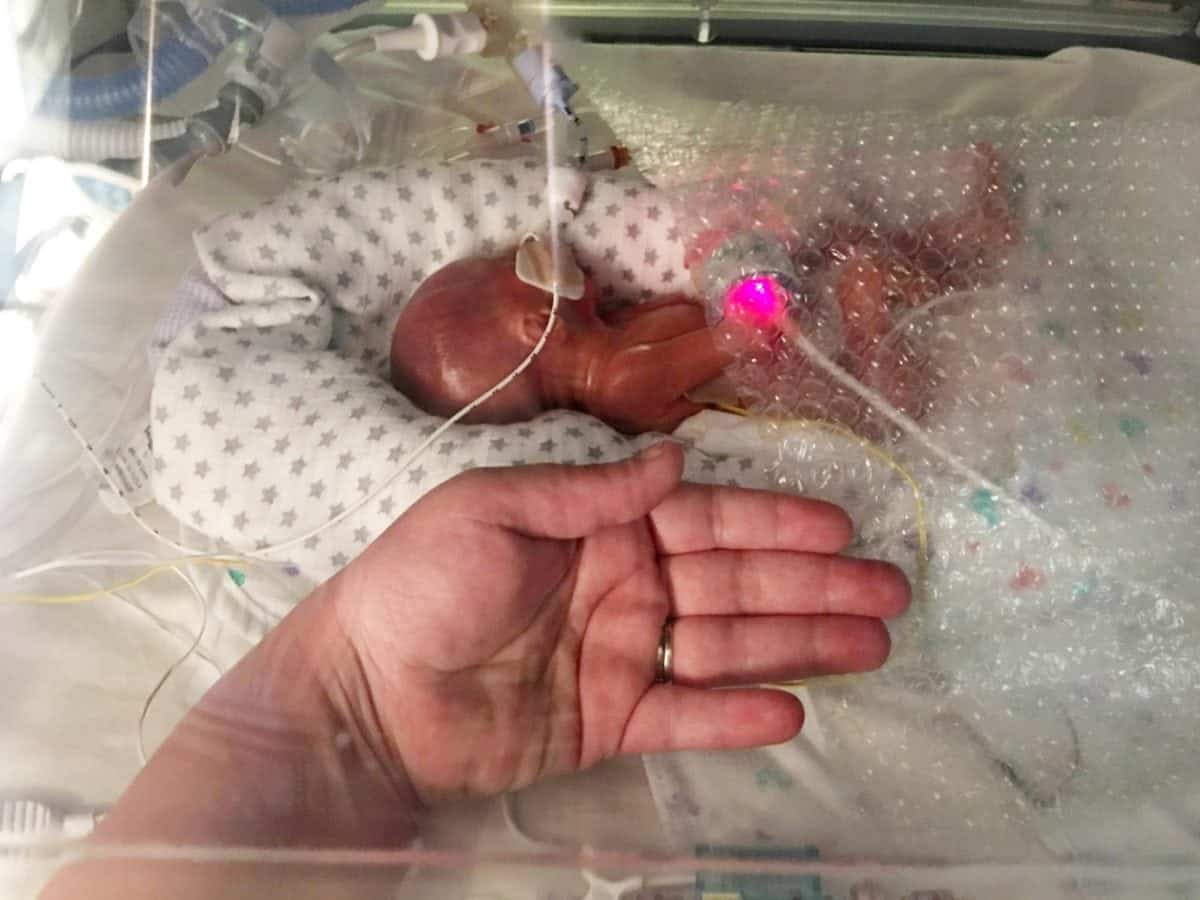 One of UK’s most premature babies defied odds after being born at 22 WEEKS weighing just 1lb 4oz.
