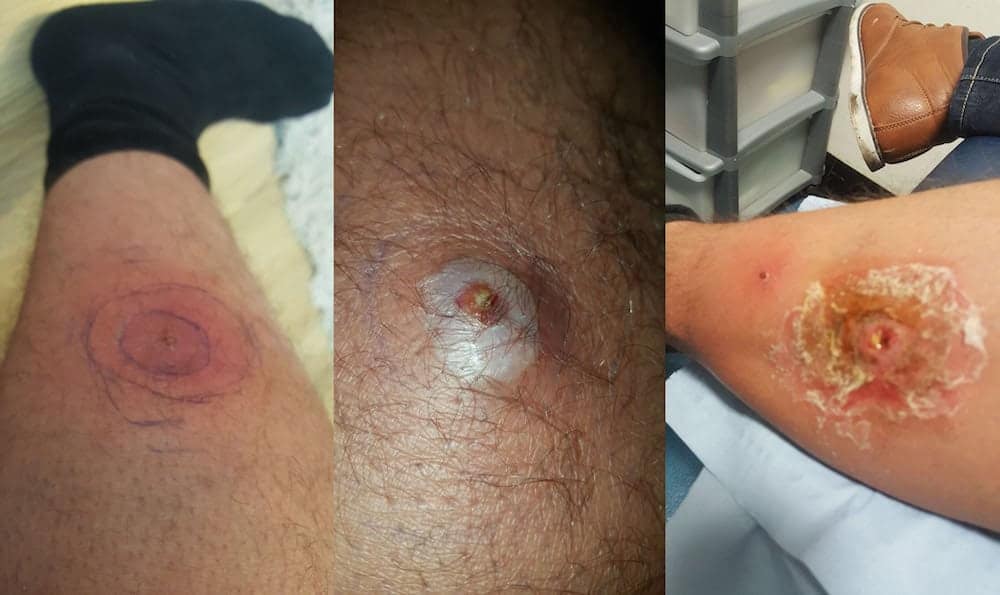 Spider bite leaves man being able to see a muscle through a hole in his leg