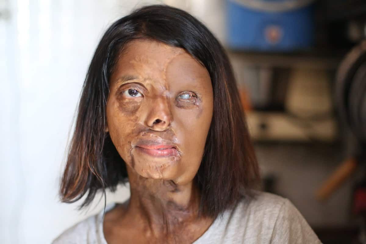 Victim scarred by father in acid attack that killed her mum appealing for £35k for operation