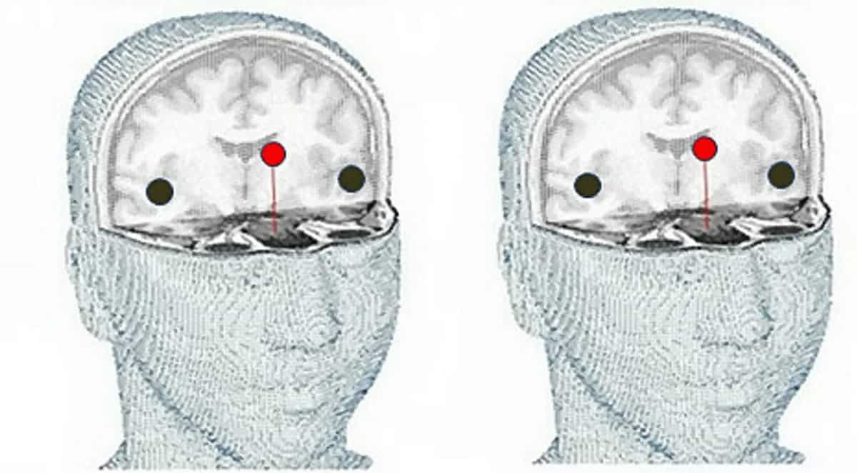 ‘Ideal biomarker’ detects Alzheimer’s Disease before the onset of symptoms