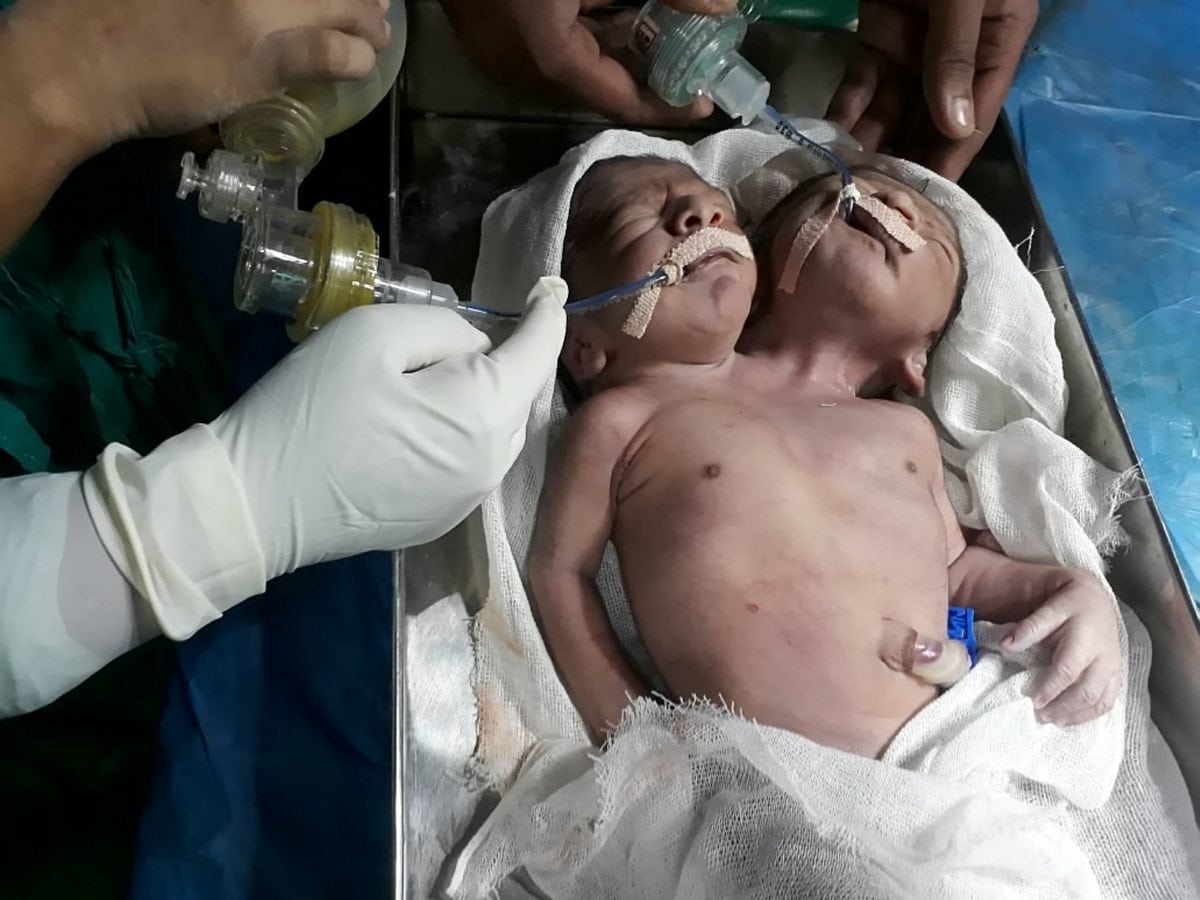 Conjoined twins born with two heads and one body die in hospital just 24 hours later