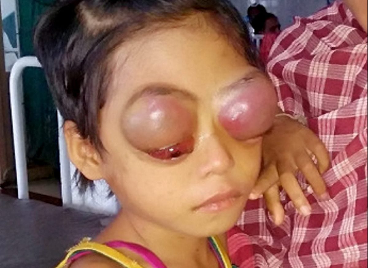 Desperate parents pleading for help to cure daughter with rare cancer that causes her eyes to bleed – and POP OUT