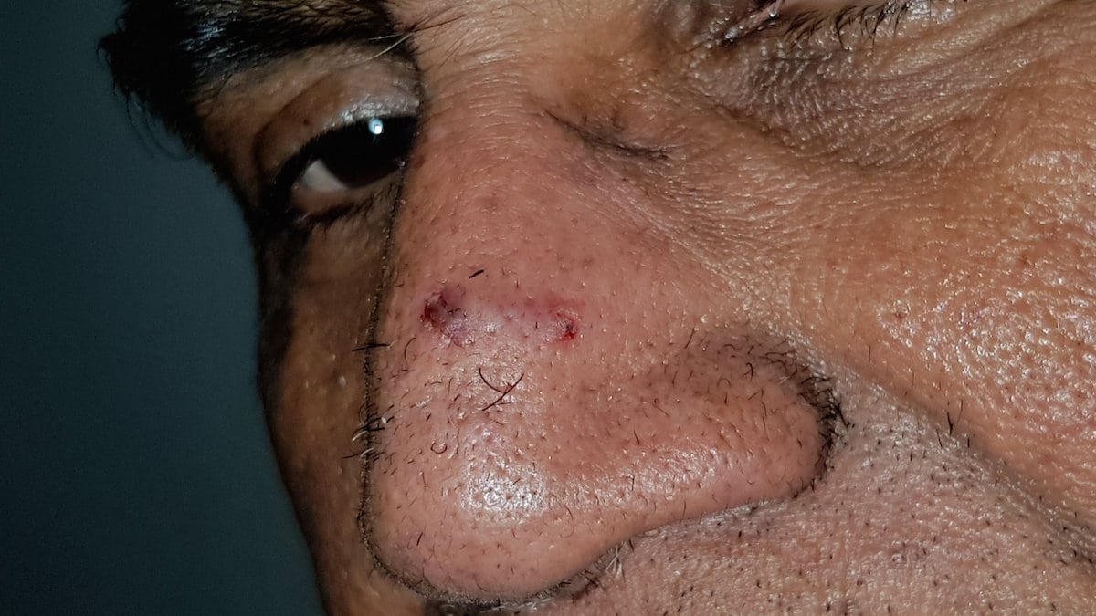A dad has been left scarred after he woke up to a RAT nibbling on his nose