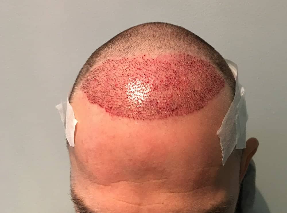 England rugby scrum-half gets hair transplant after getting taunted for going bald