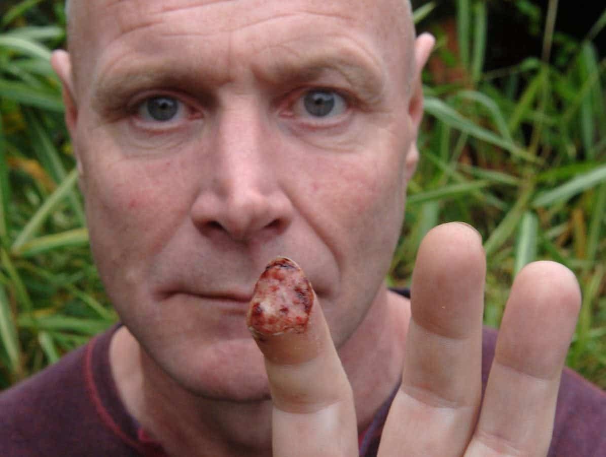 Dogwalker has finger bitten off by wild boar while walking in the woods