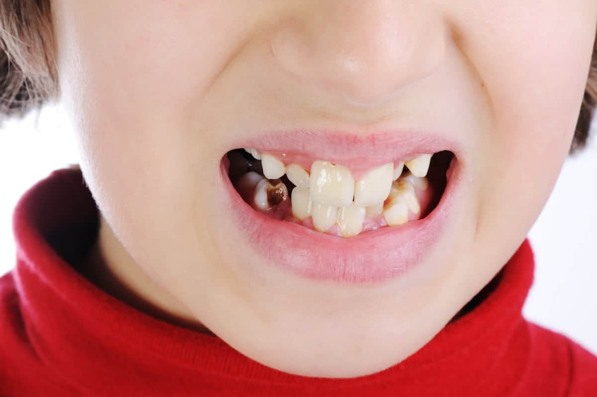 ‘Appalling childhood tooth extraction statistics illustrate need for urgent action in England’, charity declares