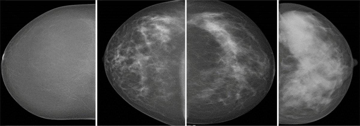 Women with dense breast tissue ‘more likely to get cancer’