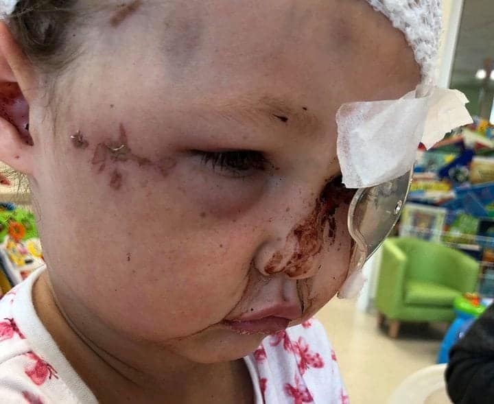 A four-year-old girl has been left with fractures to her skull & potentially blind in one eye after a vicious dog attack