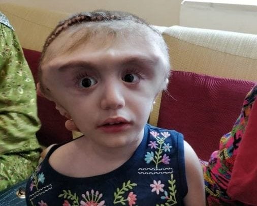 Girl, 2, with rare ‘water on the brain’ condition undergoes pioneering surgery to have 72cm head reduced