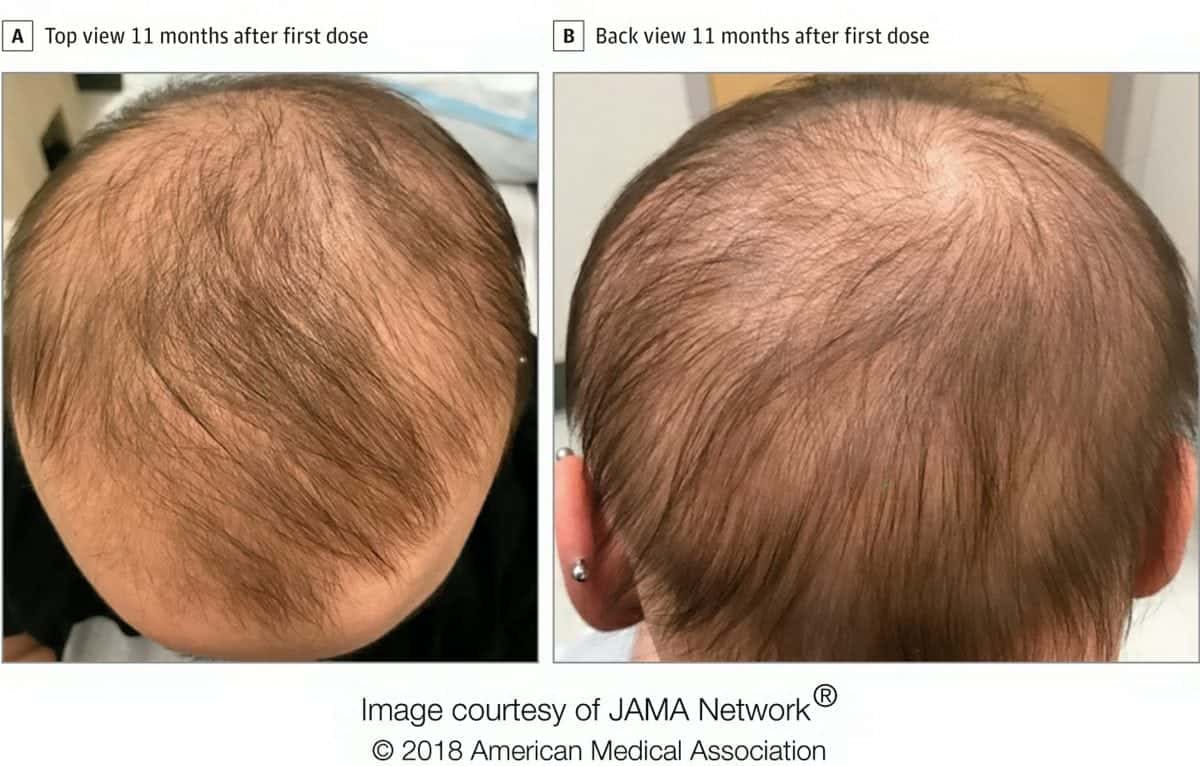 Eczema drug restores hair growth in teenager with alopecia