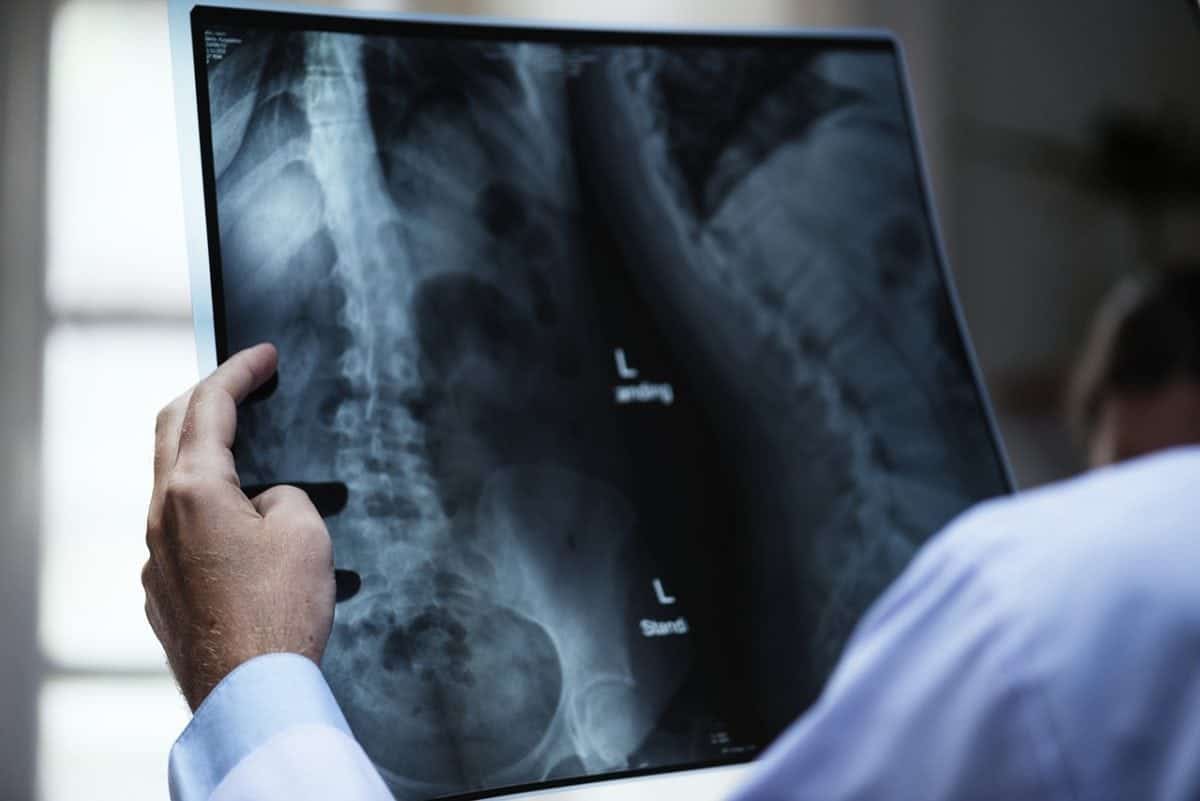 Survey shows worrying delay in diagnosing primary bone cancer