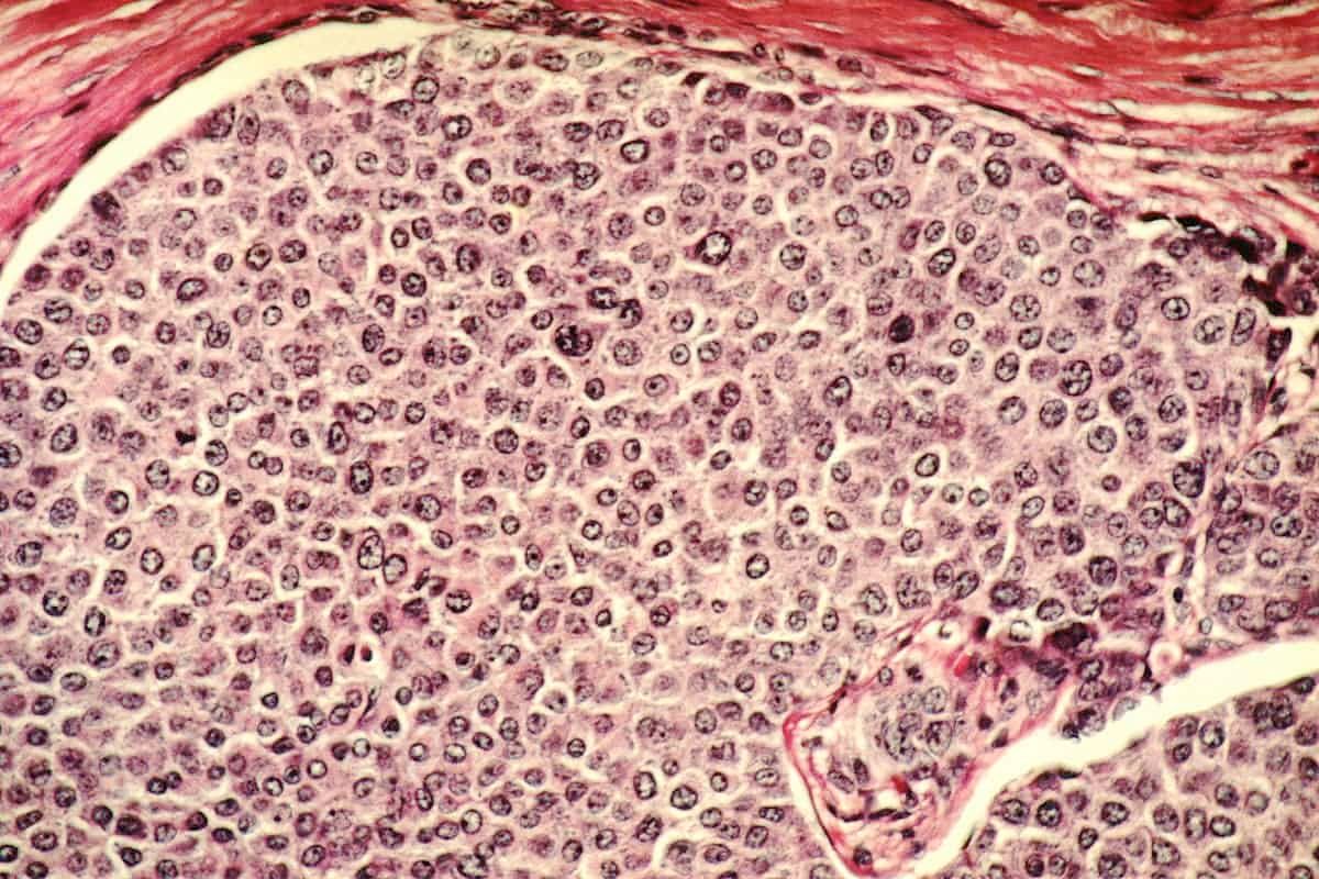 Breakthrough to stop spread of breast cancer to other organs