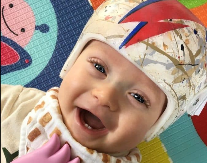 Tot with flattened head is on the road to recovery thanks to David Bowie-inspired helmet