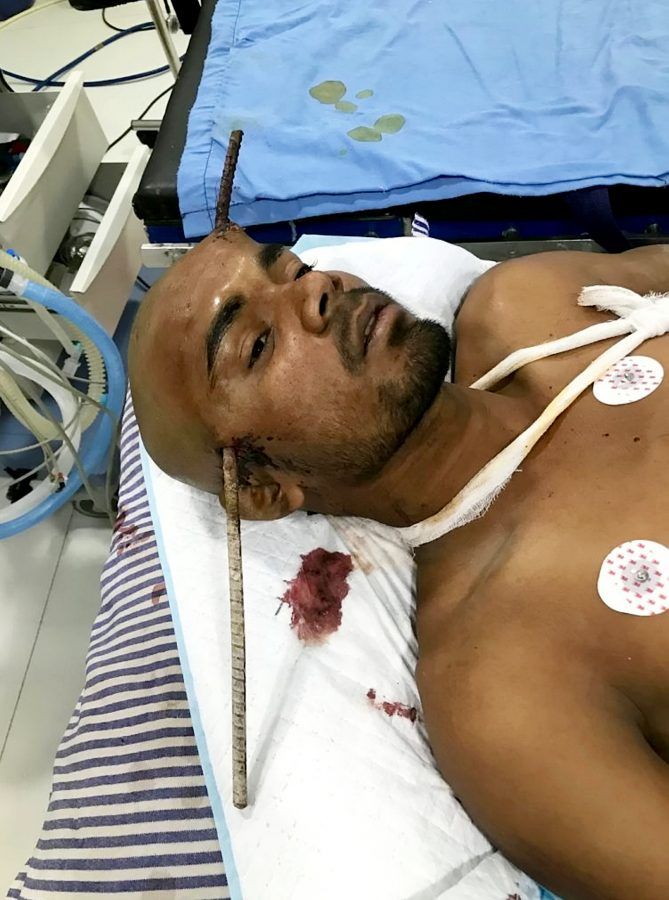 Construction worker Sanjay Bahe fell down a well and an iron rod pierced straight through his head. (c) SWNS