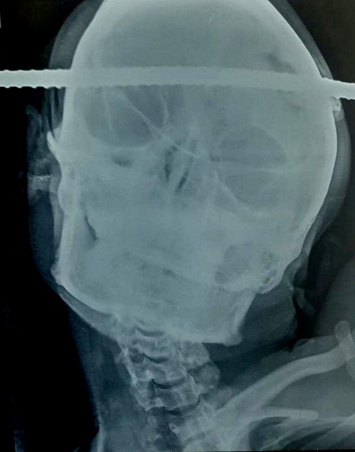 Construction worker Sanjay Bahe fell down a well and an iron rod pierced straight through his head. (c) SWNS