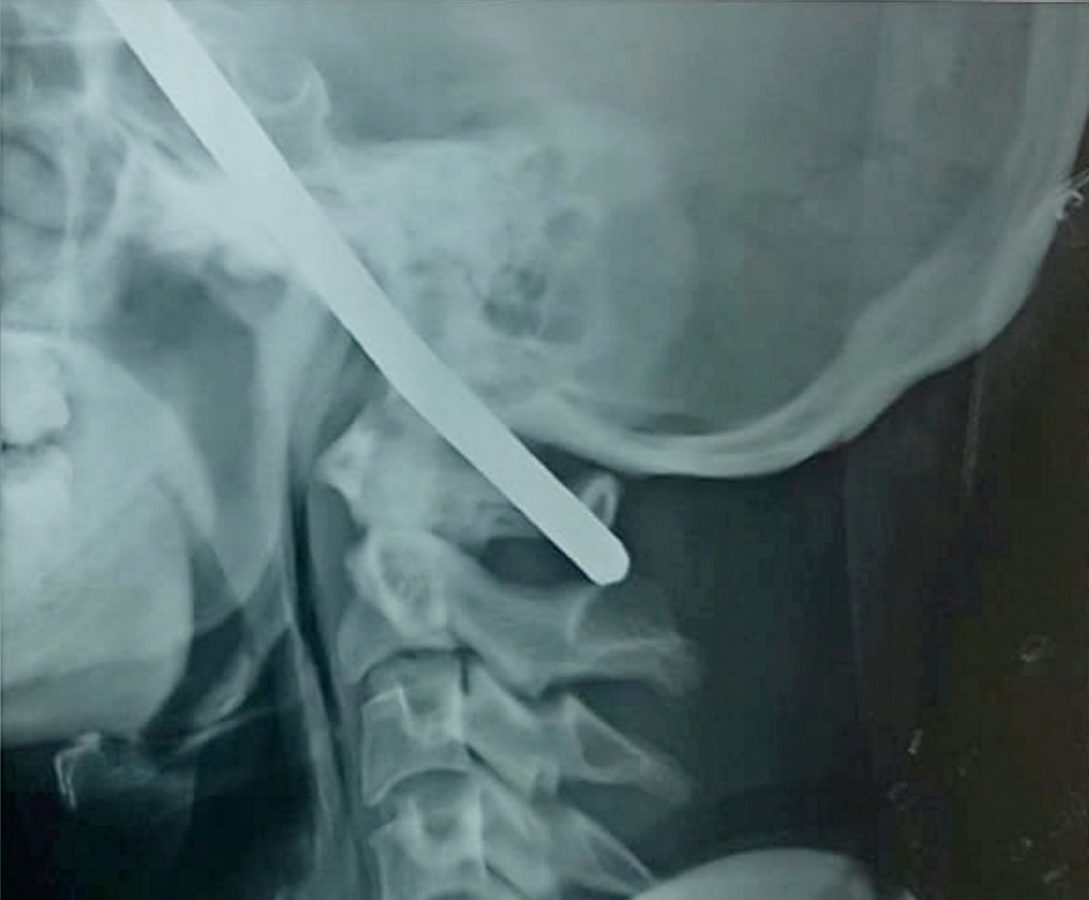 Construction worker Sanjay Bahe fell down a well and an iron rod pierced straight through his head. (c) SWNS
