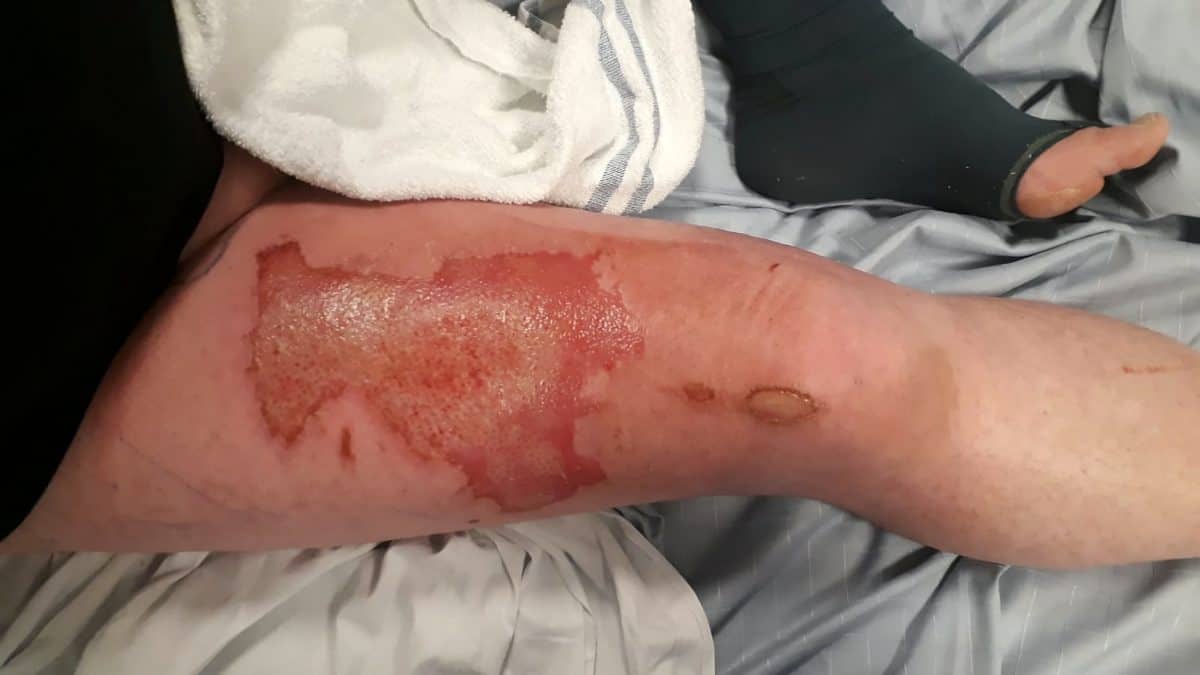 Man left with third degree burns after e-cigarette battery exploded in his pocket