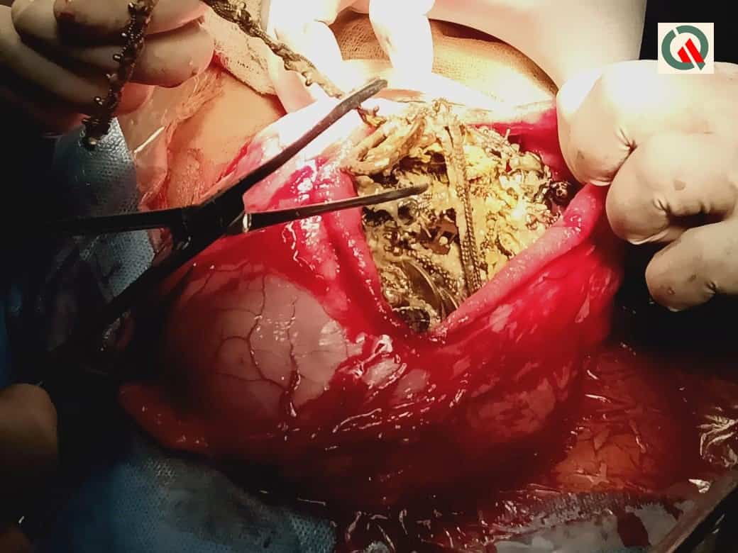 Doctors remove 1.6kg of metallic items, including jewellery, money, and a wristwatch from woman’s stomach