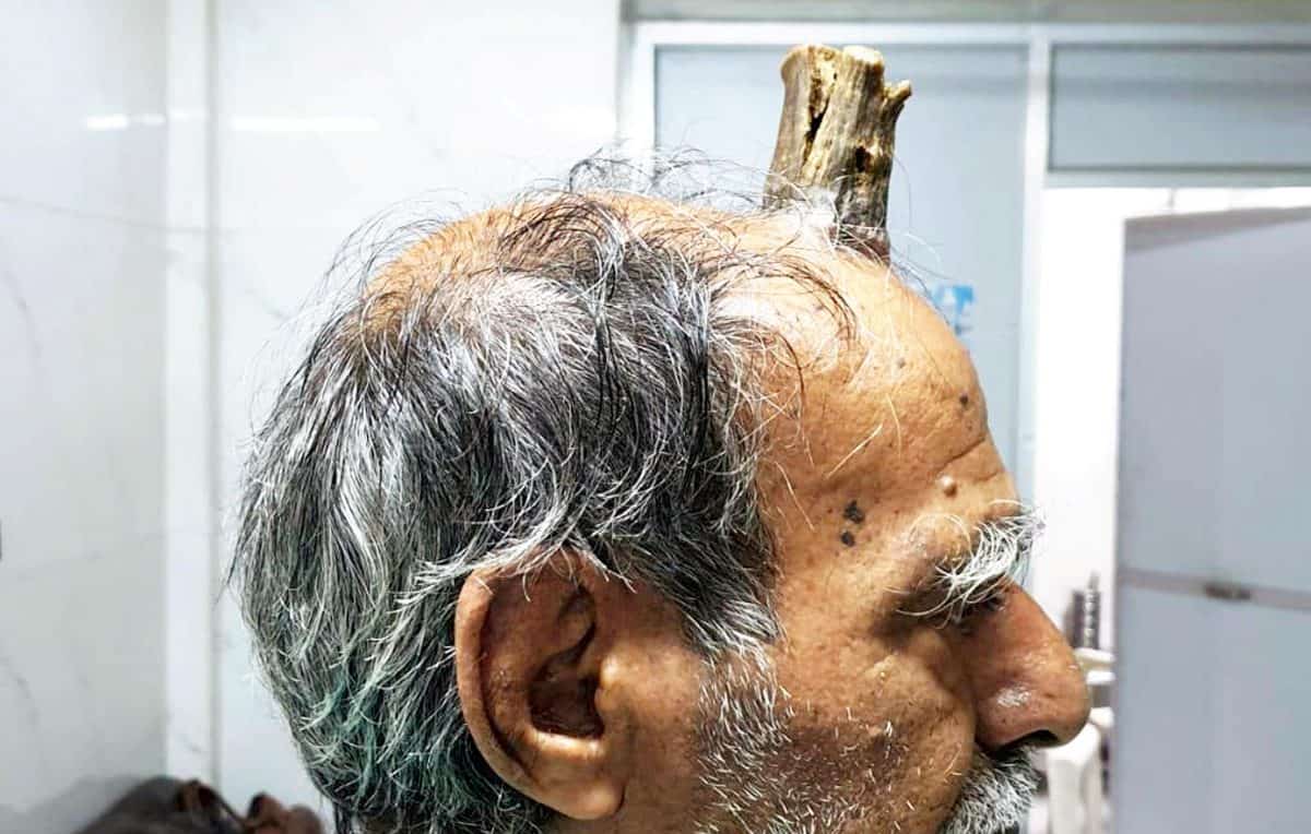 Photos show huge four inch devil horn growth removed from man’s head