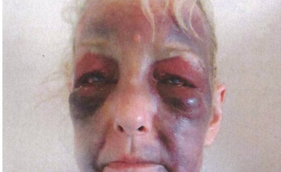 Brave domestic violence survivor shares shocking images of sickening injuries to urge other victims to get help