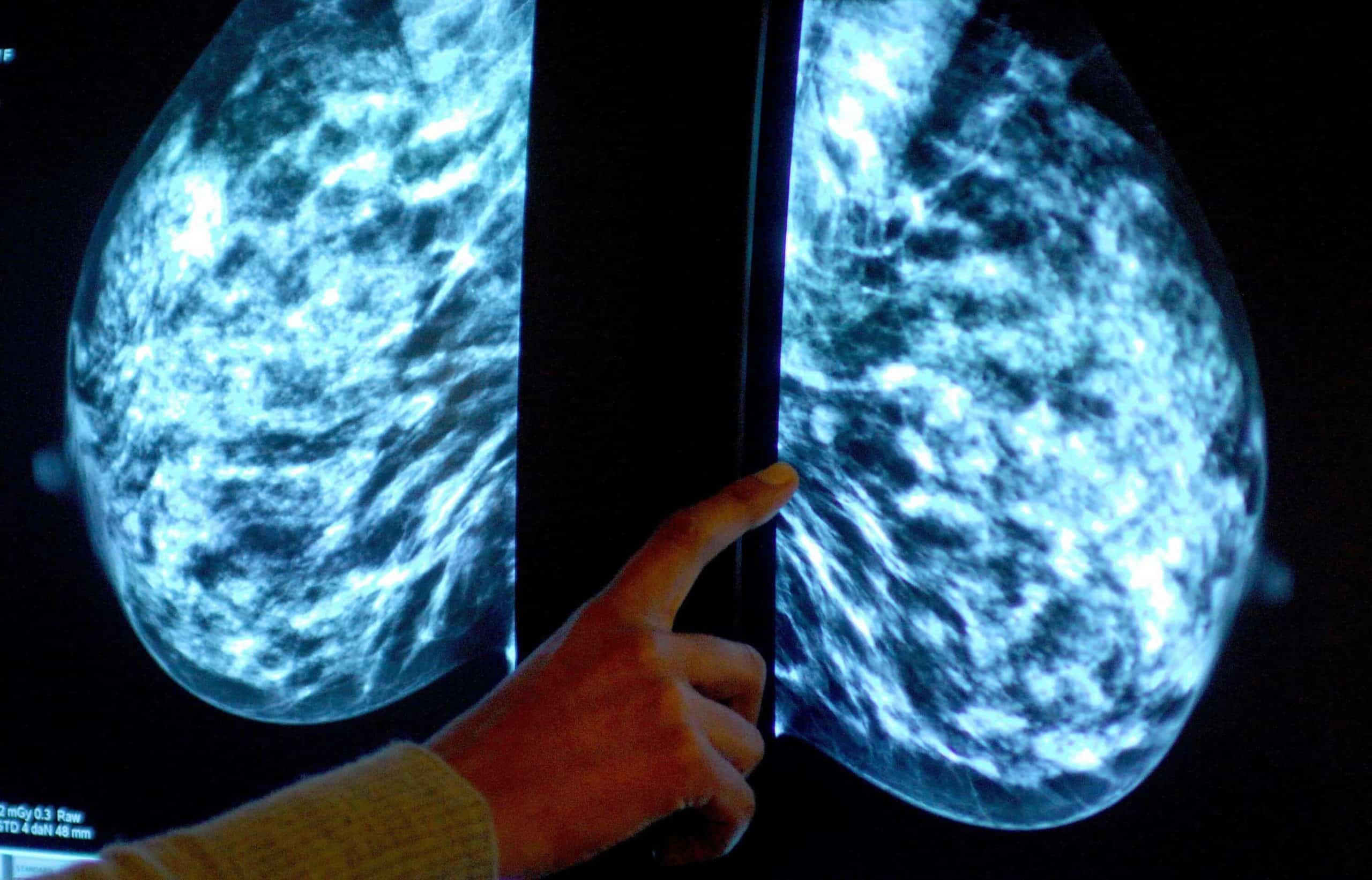 New drug overcomes resistance in aggressive breast cancers, study suggests