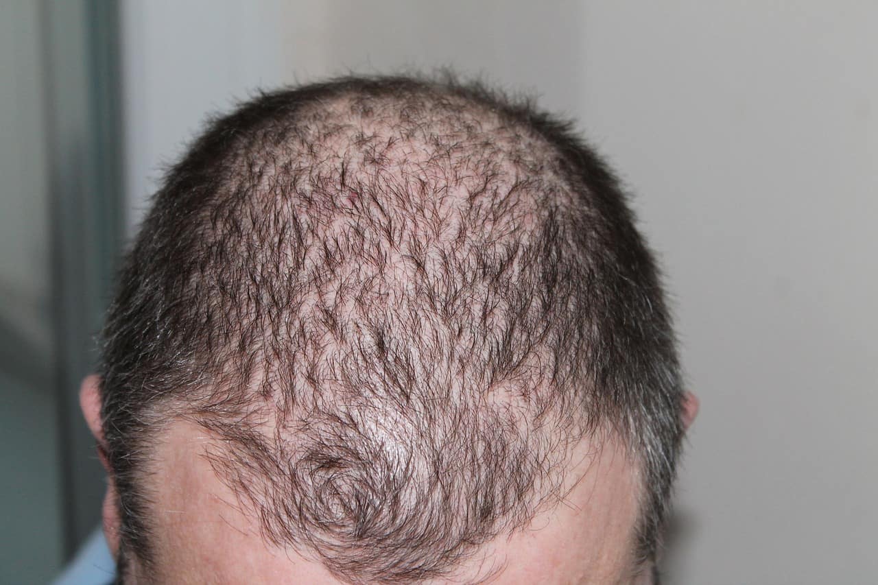 Hair Thinning and Balding – Could a Hair Transplant in Turkey Be the Solution?