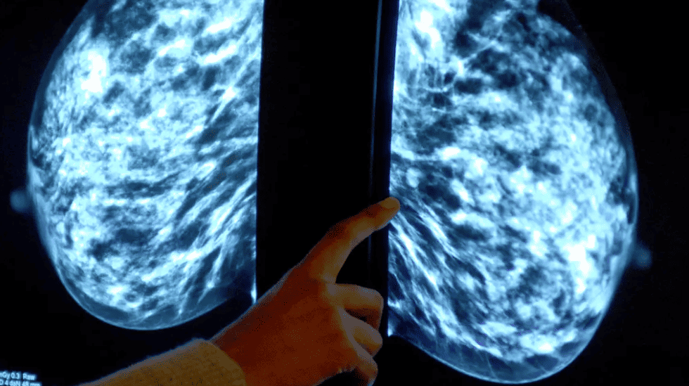Breast cancer treatment blocked for NHS use in England amid price issues